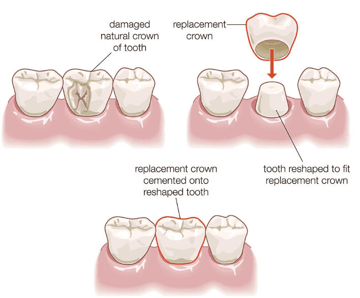 dental crowns hartsdale westchester