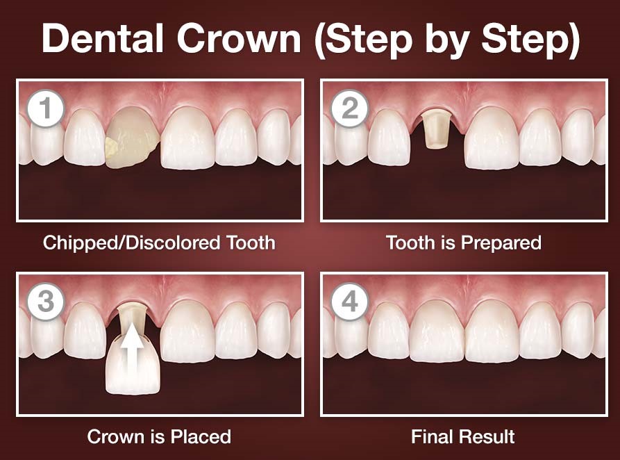 dental crowns scarsdale